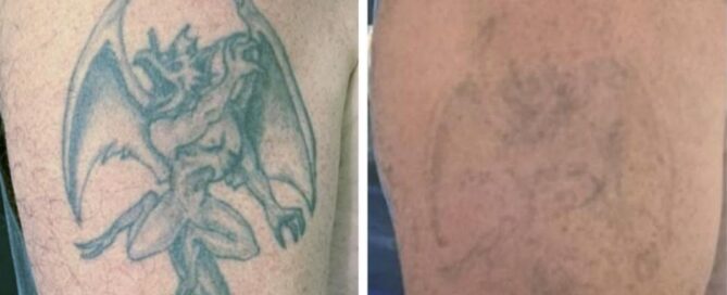 tattoo removal
