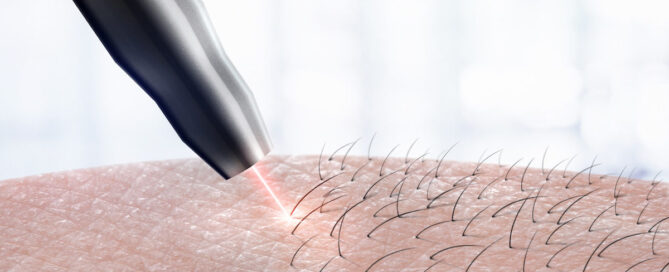 Cosmetology procedure laser hair removal on body parts