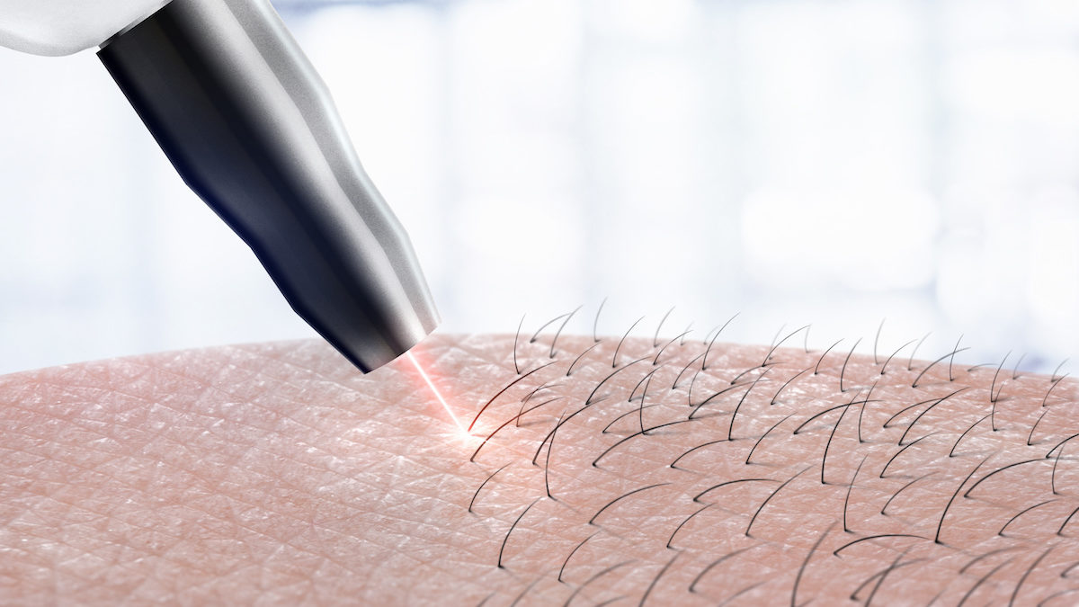 Cosmetology procedure laser hair removal on body parts