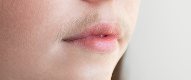 Embracing facial hair treatment