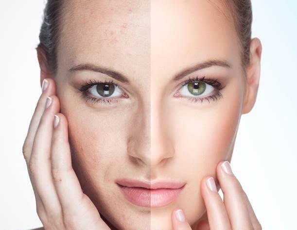 Before and after skin tightening comparison