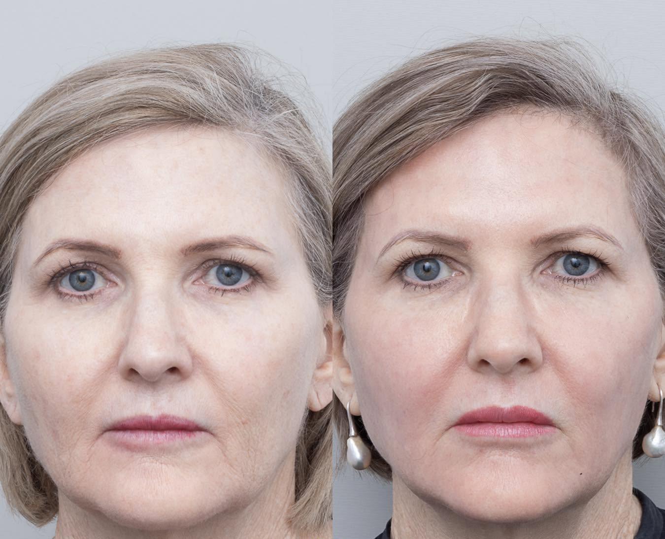 Photodynamic therapy before and after comparison