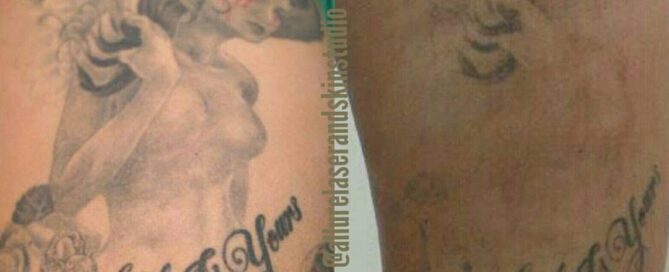 Laser tattoo removal comparison