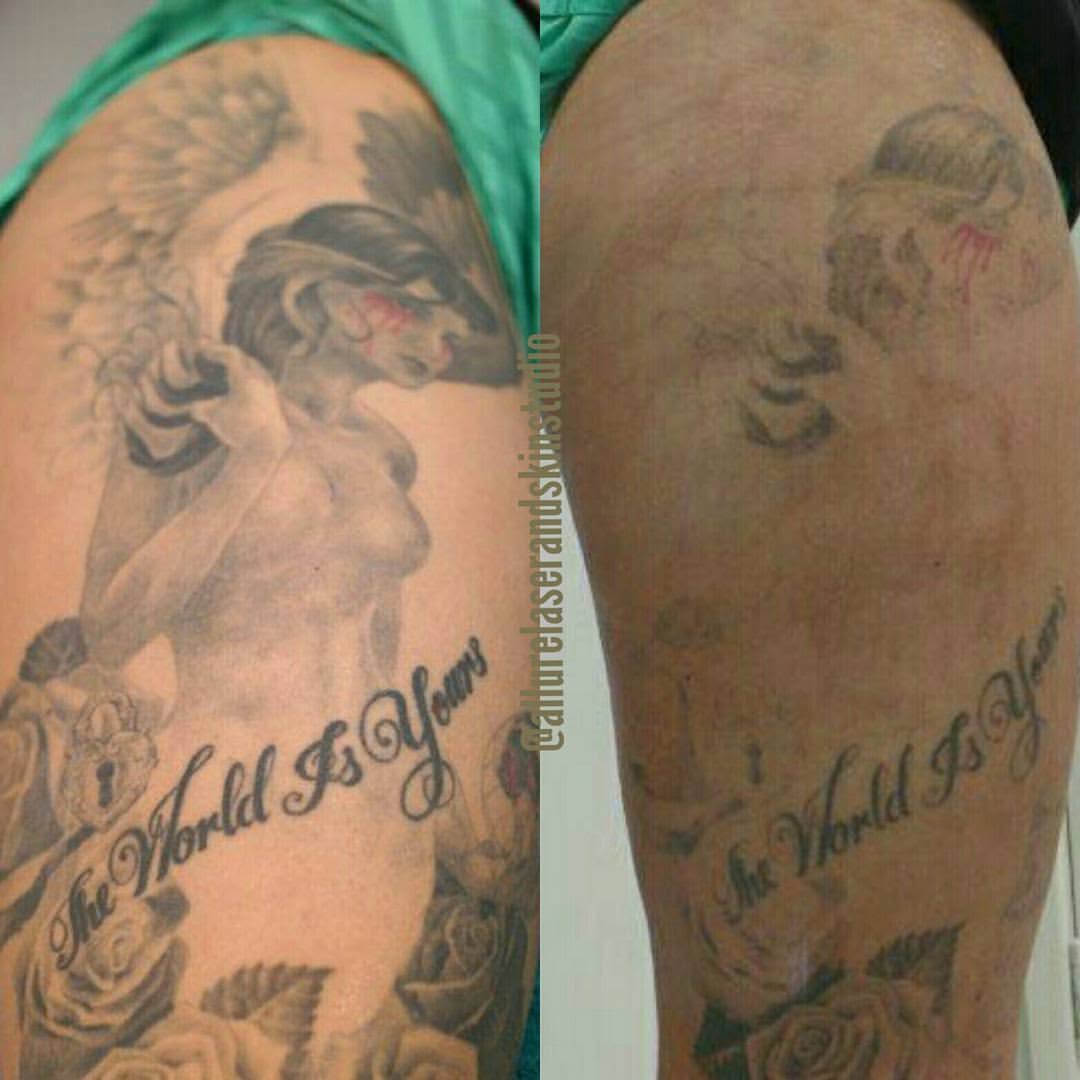 Laser tattoo removal comparison