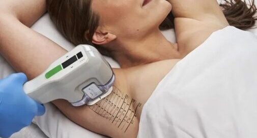 Woman undergoing MiraDry Treatment