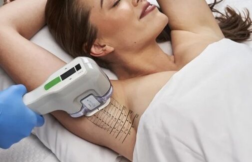 Woman undergoing MiraDry Treatment