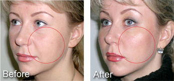 Facial thread before and after comparison